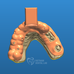 Implant Impression Trays