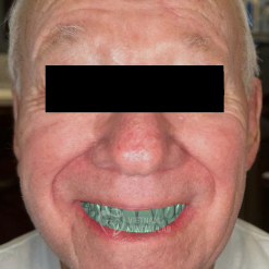 Immediate Denture