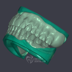 Reline denture 2 arch