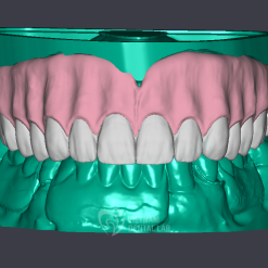 Reline denture and split file