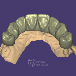 Cement Retained Full Contour