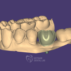 Screw-Retained Cutback