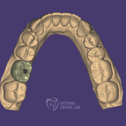 Screw-Retained