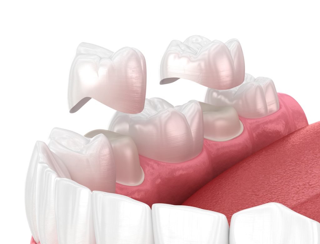 how to choose the right crowns bridges and veneers for your patients 67b4b6dfa1a61 - How to Choose the Right Crowns, Bridges, and Veneers for Your Patients - Vietnam Dental Lab
