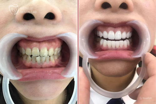 Transforming smiles with advanced technology at Vietnam Dental Lab.