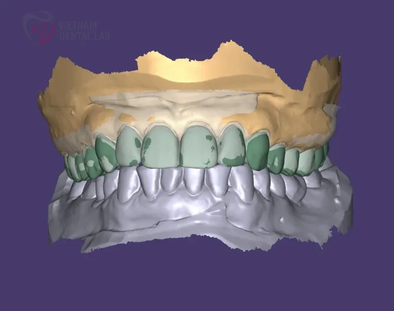 812 eut 1 - Deliver Your CAD/CAM Cases On Time - Vietnam Dental Lab