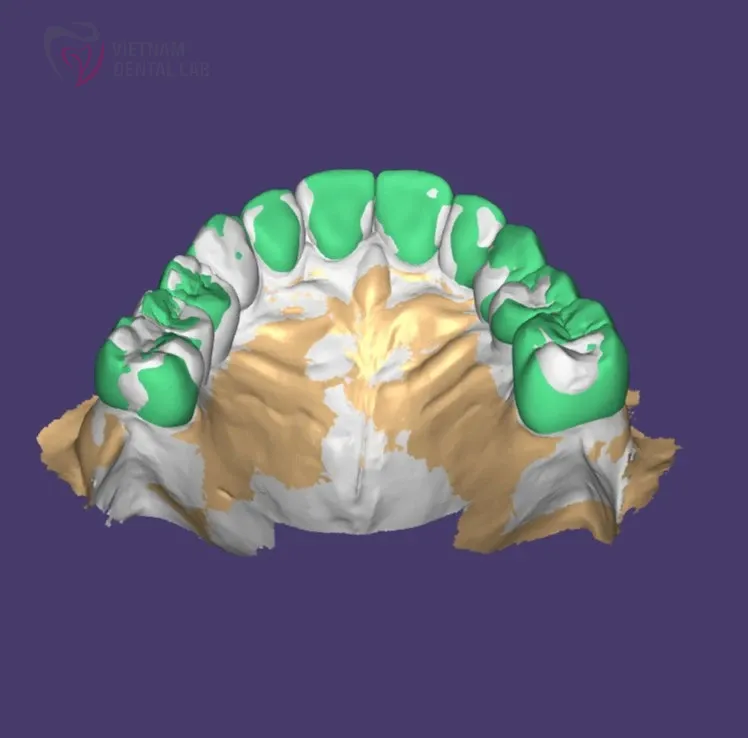 9uz b5y 3 - Deliver Your CAD/CAM Cases On Time - Vietnam Dental Lab