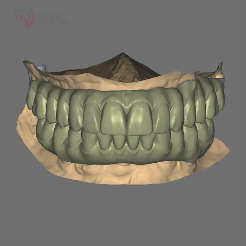 all1 full - Deliver Your CAD/CAM Cases On Time - Vietnam Dental Lab