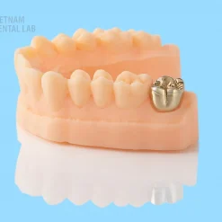 Metal crowns