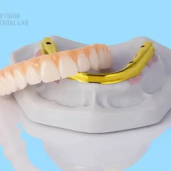 All on X implant bars and frameworks