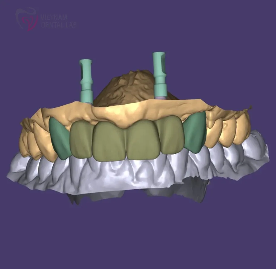 full crowns ml7 s1a 1 - Deliver Your CAD/CAM Cases On Time - Vietnam Dental Lab