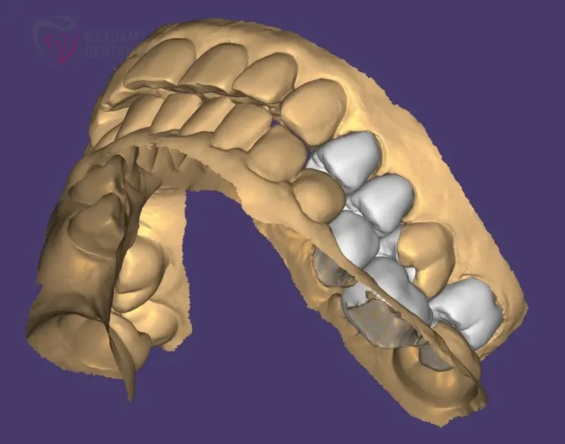 full crowns s4j tj3 2 - Deliver Your CAD/CAM Cases On Time - Vietnam Dental Lab