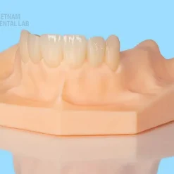 Temporary crowns & bridges