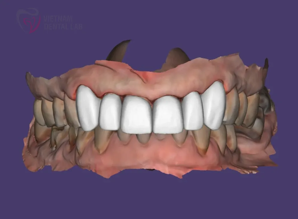 y0f 3xc 1 - Deliver Your CAD/CAM Cases On Time - Vietnam Dental Lab