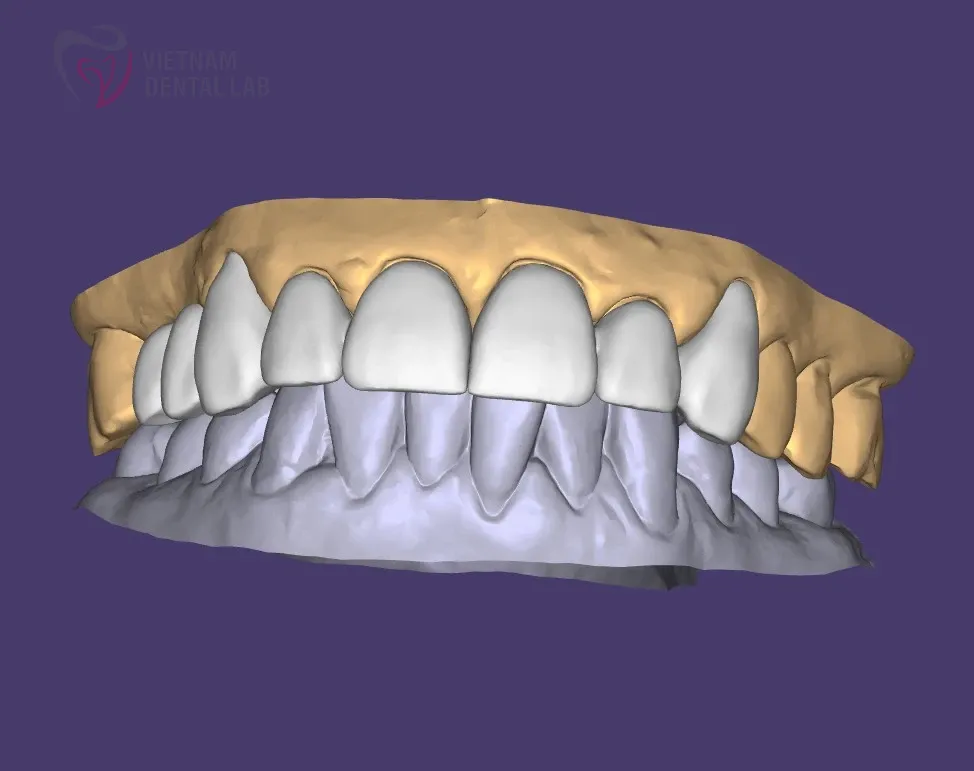 zoz z07 1 - Deliver Your CAD/CAM Cases On Time - Vietnam Dental Lab