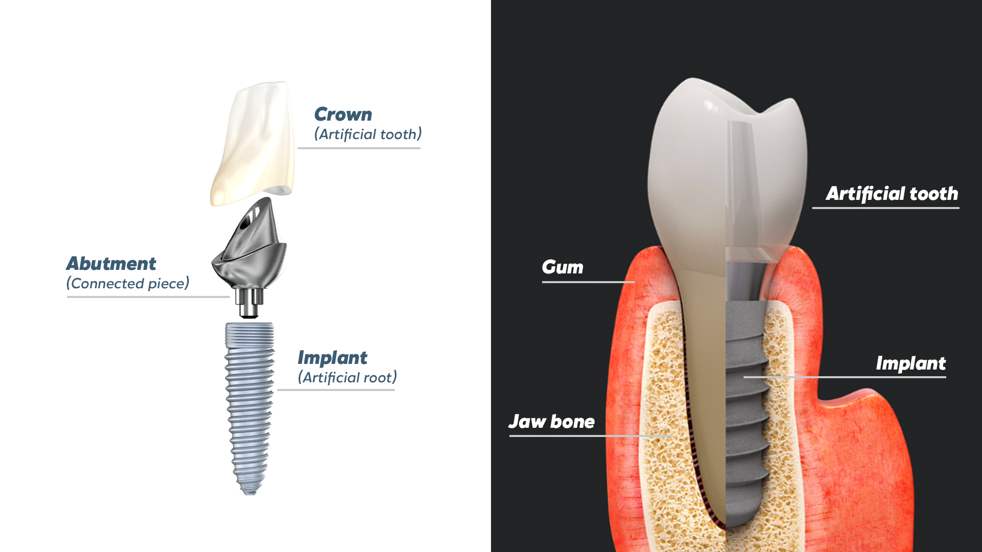 Dental Implants : types, surgery procedure, and cost