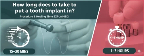 How long does it take to put a tooth implant in - How long does it take to put a tooth implant in? The complete timeline - Vietnam Dental Lab