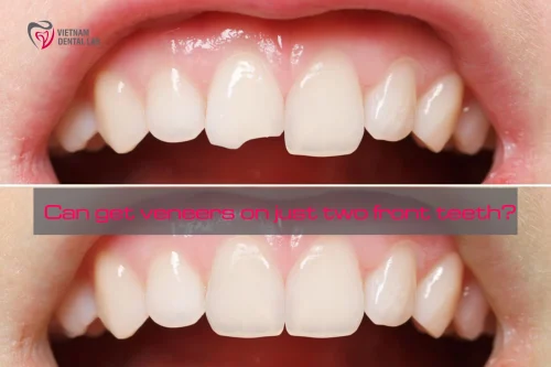 can i get veneers on just my two front teeth - Can get veneers on just two front teeth? - Vietnam Dental Lab