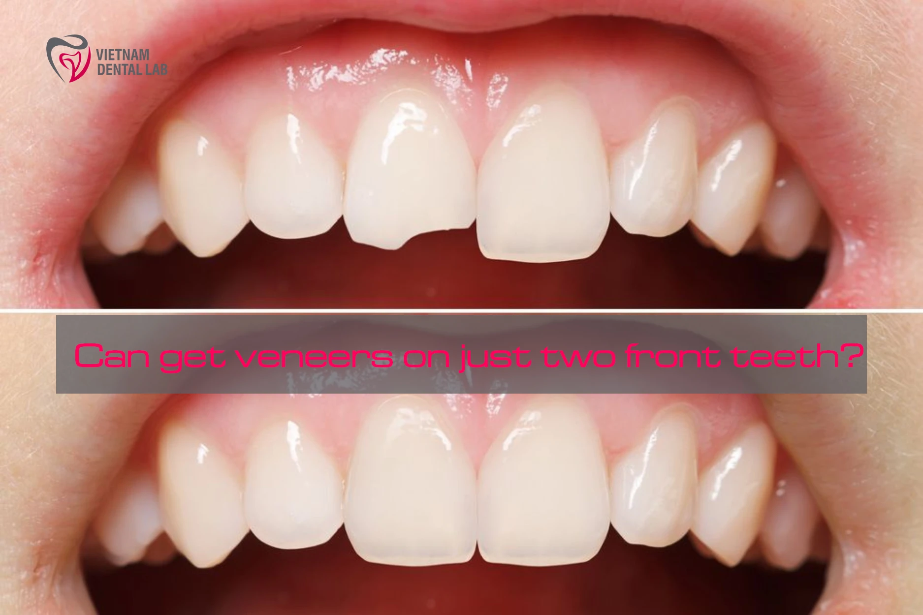 - - Vietnam Dental Lab